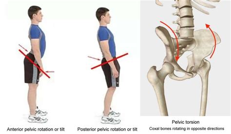 pelvic torsion test|lateral pelvic torsion.